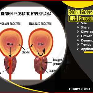 Benign Prostatic Hyperplasia